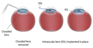 Intraocular Lenses (IOLs) - Information | Boston Eye Group